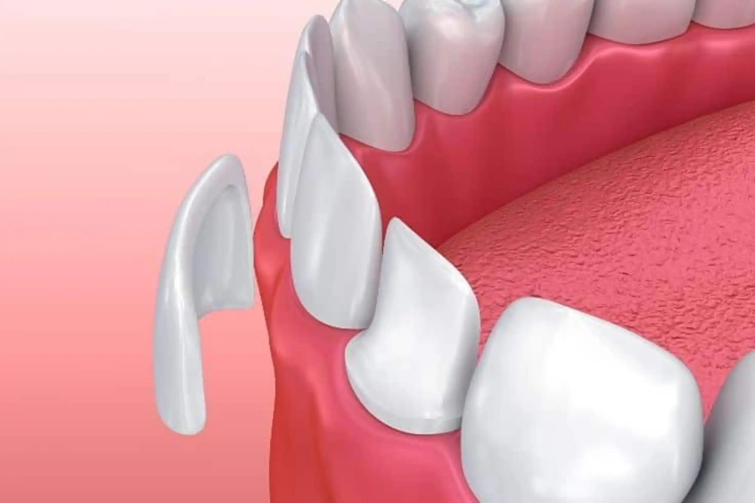 Tips Merawat Veneer Gigi