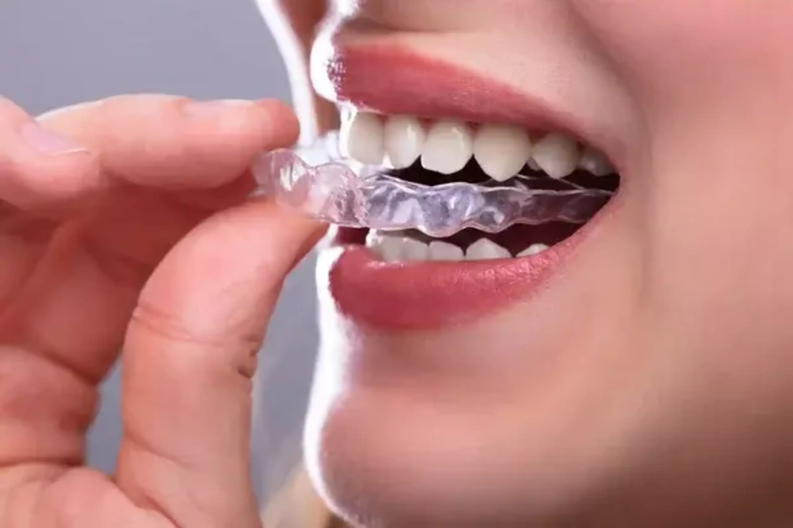 Clear Aligner Solusi Gigi Rapi Tanpa Bracket