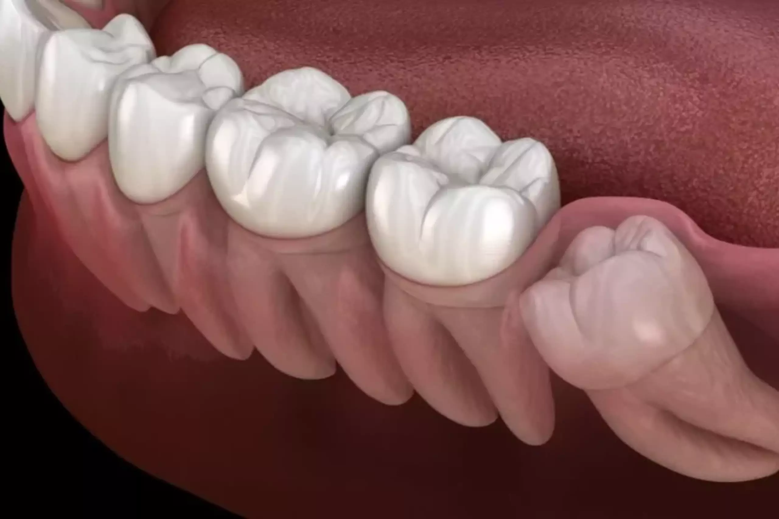 Gigi Geraham Sakit Saat Mengunyah? Konsultasi di Dental Clinic Terdekat