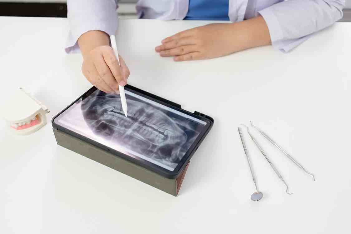 Root Canal Treatment untuk Mengatasi Gigi yang Sakit