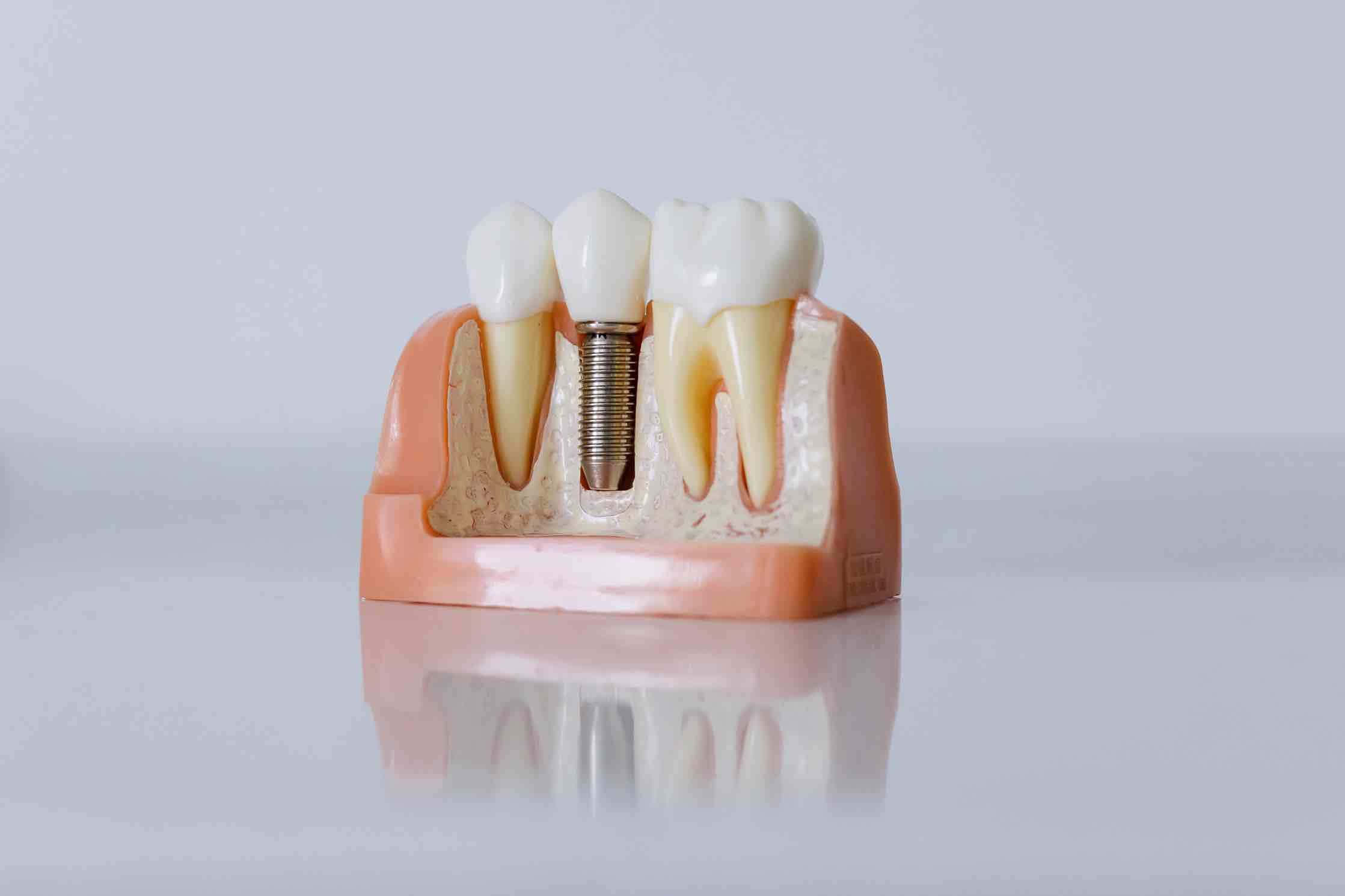 Kelebihan dan Kekurangan Gigi Implant