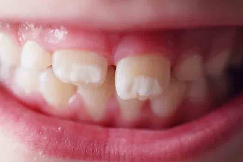 Penyebab Bercak Putih pada Gigi Anak