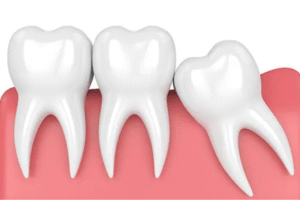 3 Ciri Gigi Tumbuh Tidak Normal
