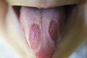 Ciri Lidah yang Tidak Sehat