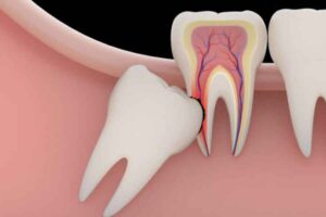 Cara Alami Hilangkan Bau Mulut