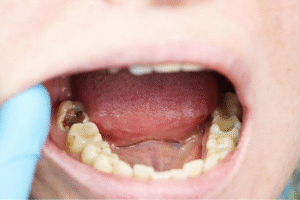 Gigi Kamu Sudah Berlubang? Ini Solusinya