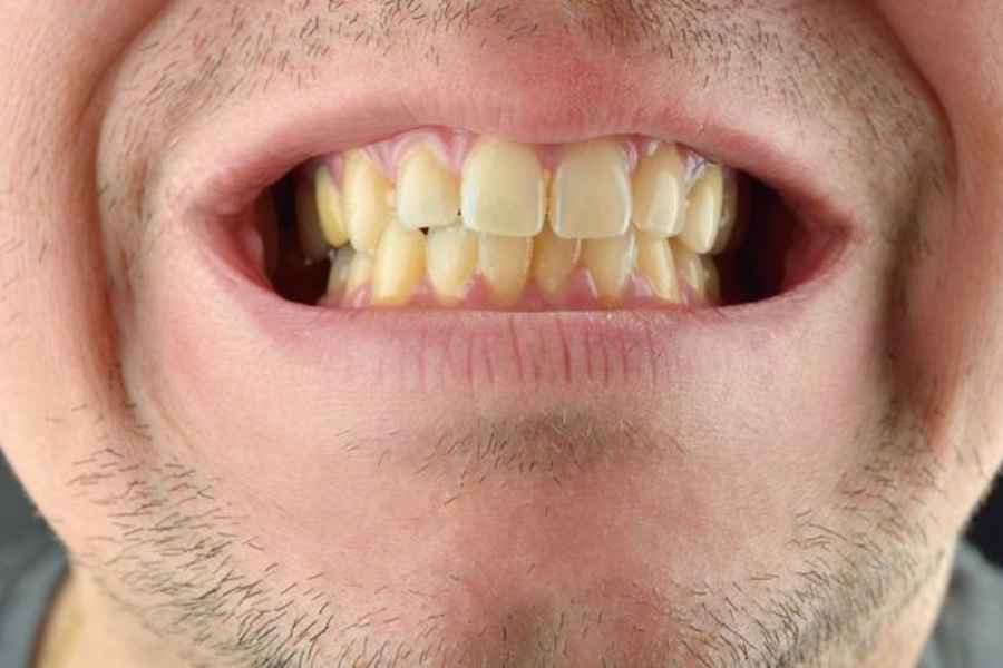 Ini Penyebab Gigi Kuning