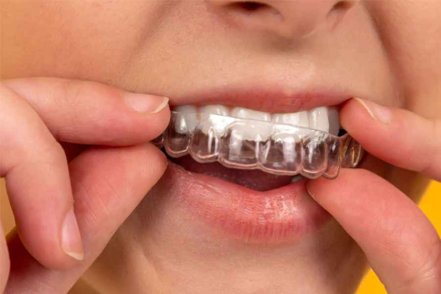 Ini Alasan Kamu Perlu Clear Aligner