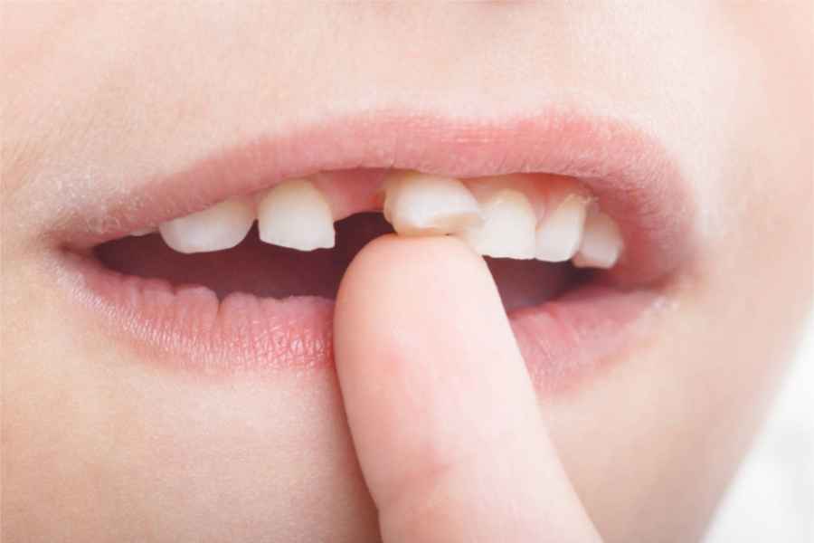 Cara Rawat Gigi Susu pada Anak agar Tetap Sehat