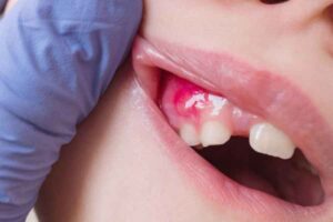 3 Tanda Infeksi Gusi yang Tidak Boleh Diabaikan