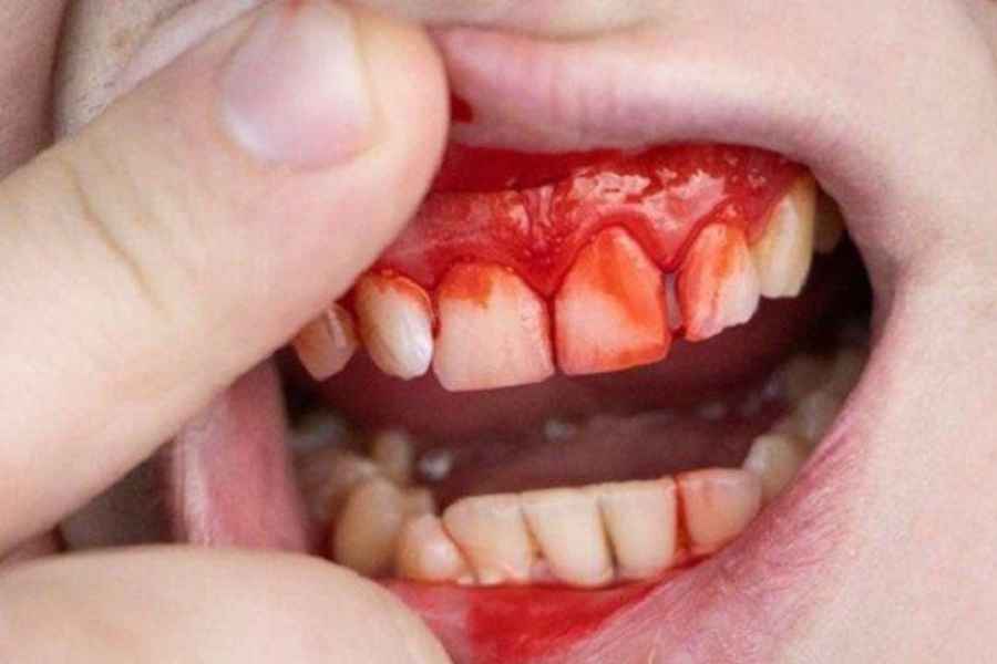 Gusi Berdarah? Ini Solusinya