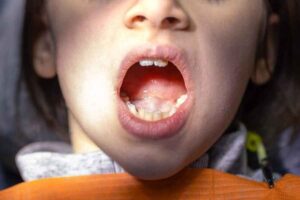 Tips Cegah Infeksi Mulut