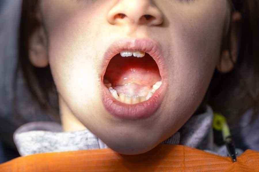 Tips Cegah Infeksi Mulut