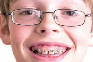 Cara Cegah Gigi Tonggos