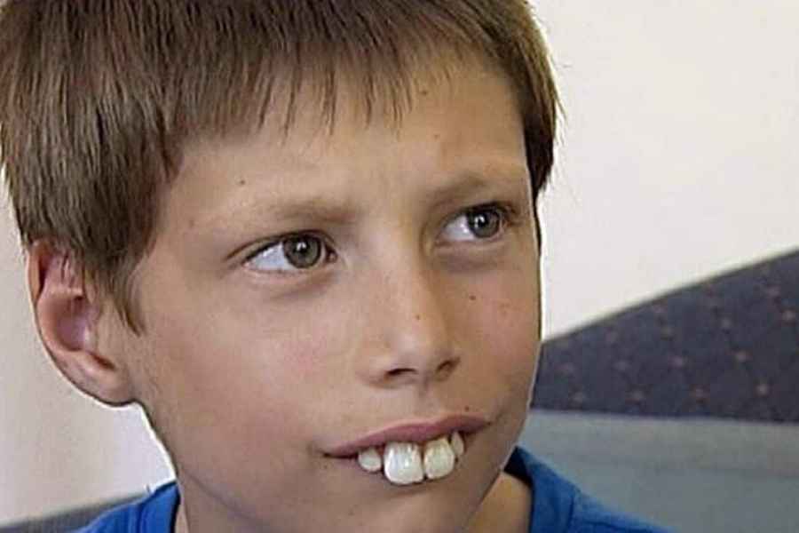 Penyebab Gigi Tonggos