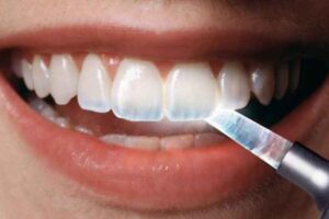 Ciri Email Gigi yang Sehat